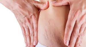 Tratamiento para estrías con activación de microcirculación